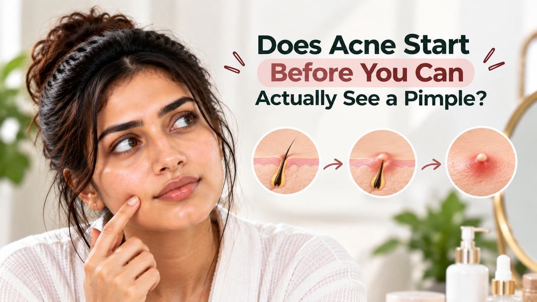 Does Acne Start Before You Can Actually See a Pimple?